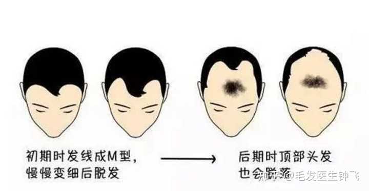 M字脱发有解吗 知乎 M字脱发有解吗 知乎