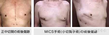心脏搭桥手术真的有效安全吗 知乎 心脏搭桥手术真的有效安全吗 知乎
