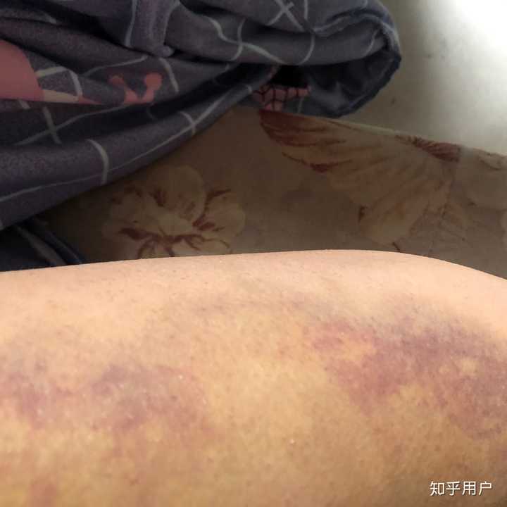 上图了,皮带抽的,胳膊背上全身都是,这是第七天了,分手他不愿意