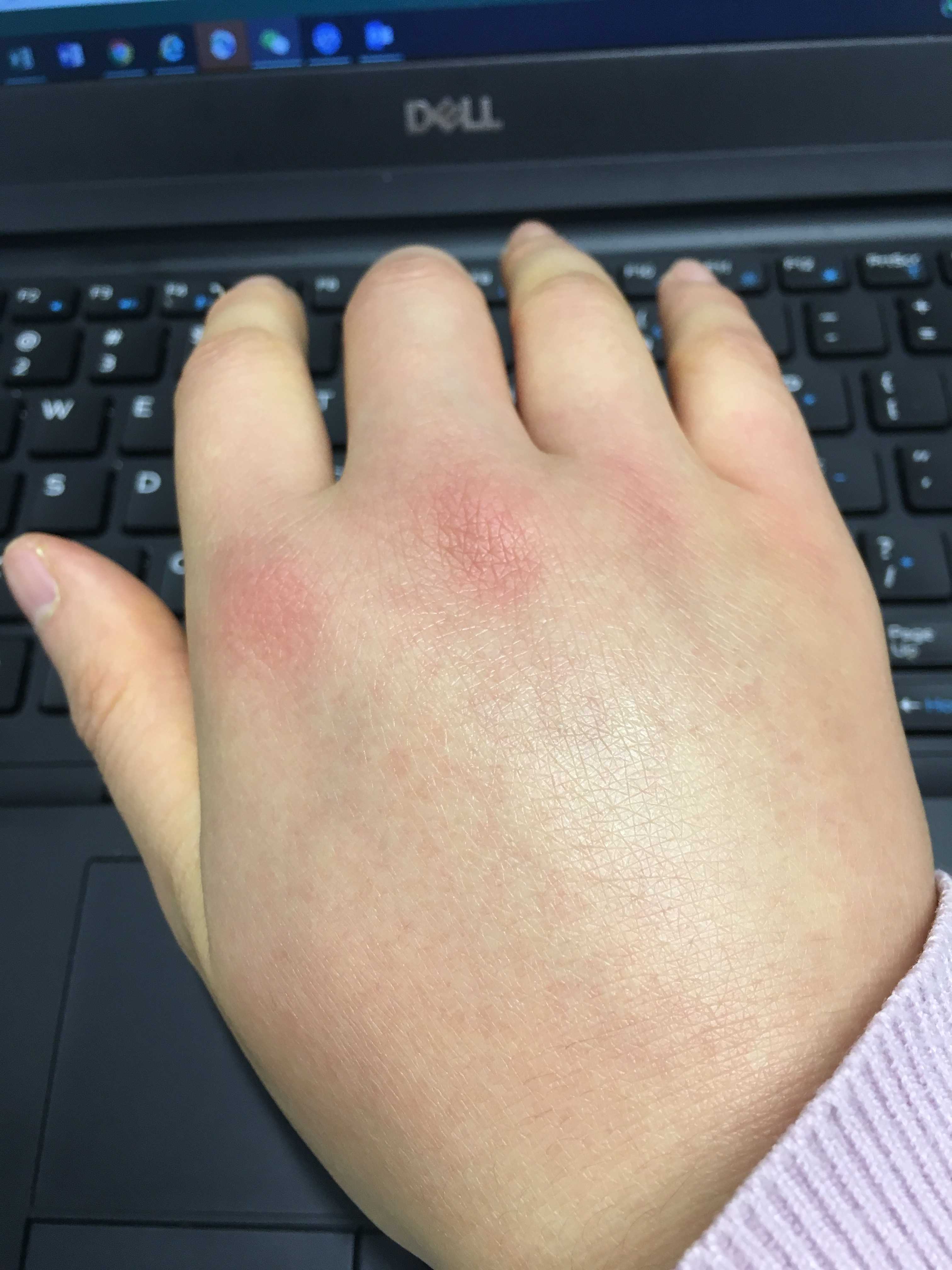 被小黄蜂蜇伤第三天 - 知乎