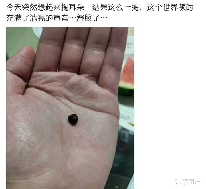 耳屎能大到什么程度?