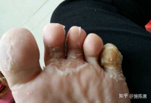 脚气为什么无法根除 知乎 脚气为什么无法根除 知乎