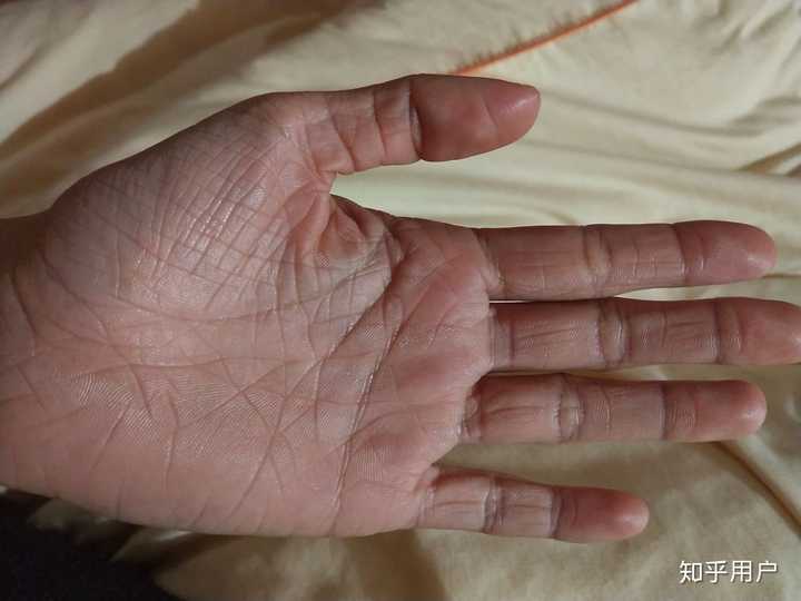 鱼鳞病还有未来吗 知乎