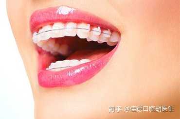 合肥箍牙多少钱?