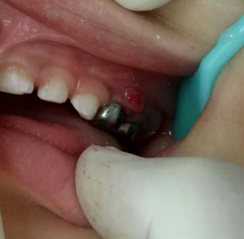 儿童乳牙牙根戳破牙龈图片