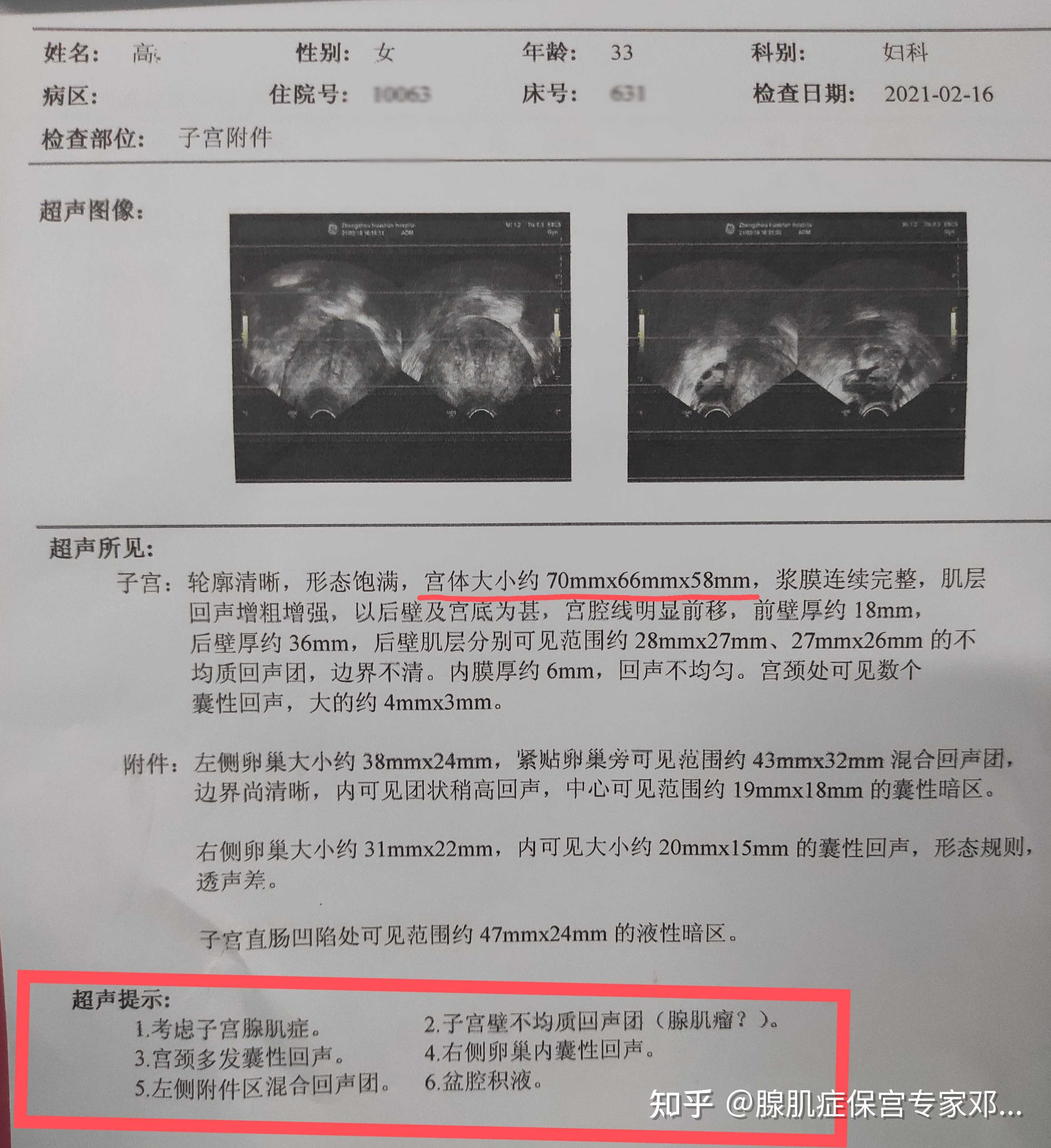 腺肌症保宮專家鄧元琪 的想法: 才33歲,2次上曼月樂環,第二次上環後5