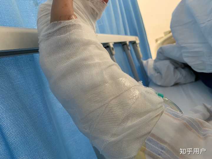 分手喝断片了,割腕 神经肌腱各断了一根,医药费快两万了,手腕很长一道