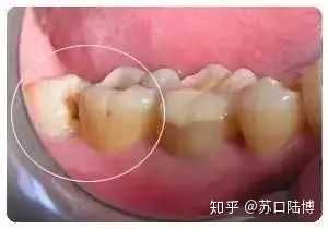 为什么大部分人会长智齿而有些人不长智齿 长智齿有何利弊 知乎