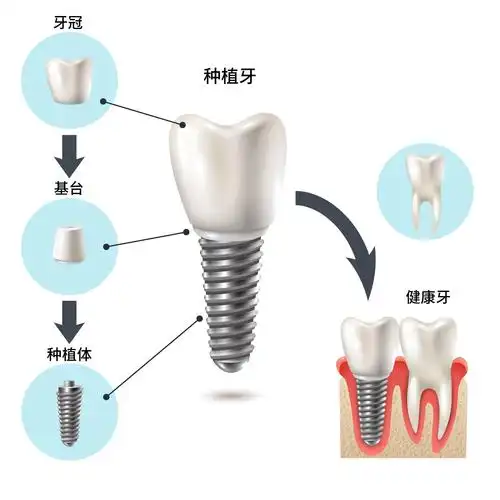 种植牙的基台是什么? - 知乎
