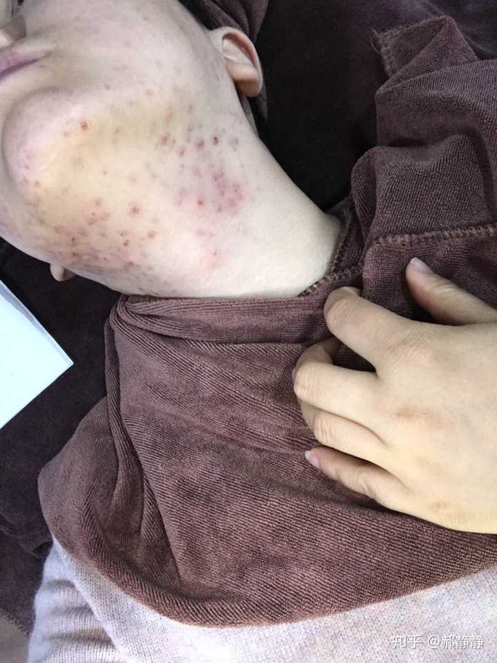 总是两腮长痘是怎么一回事？如何治疗啊