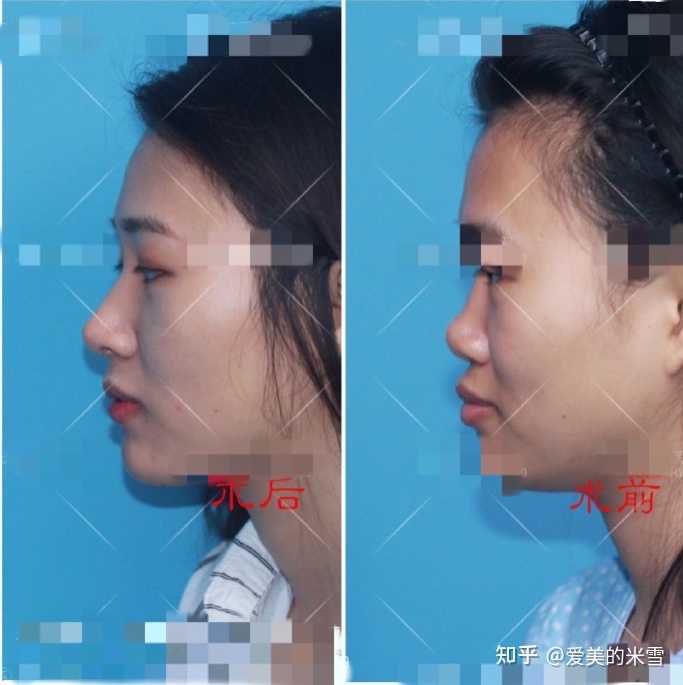 塌鼻梁女生一定不好看吗 知乎 塌鼻梁女生一定不好看吗 知乎