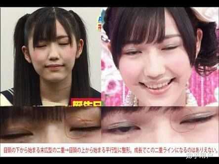 指原莉乃整容了吗 匿名用户的回答 知乎 指原莉乃整容了吗 匿名用户的回答 知乎