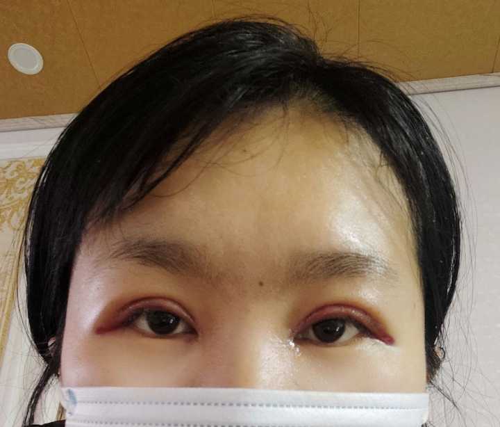 刚割完双眼皮是不是都特丑啊？