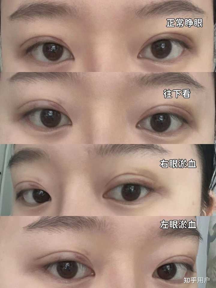 埋线法双眼皮价格_双眼皮埋线价格_双眼皮法埋线价格多少