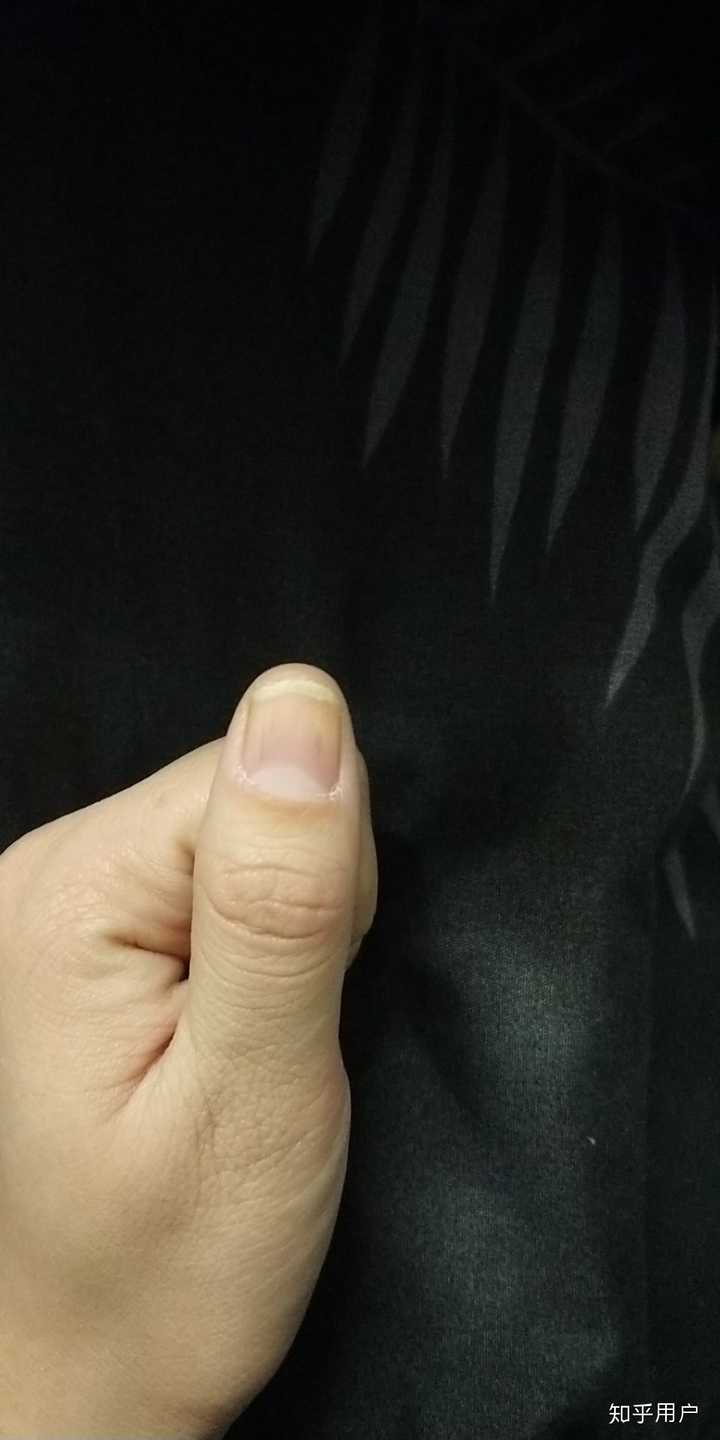 灰指甲疼吗 知乎 灰指甲疼吗 知乎