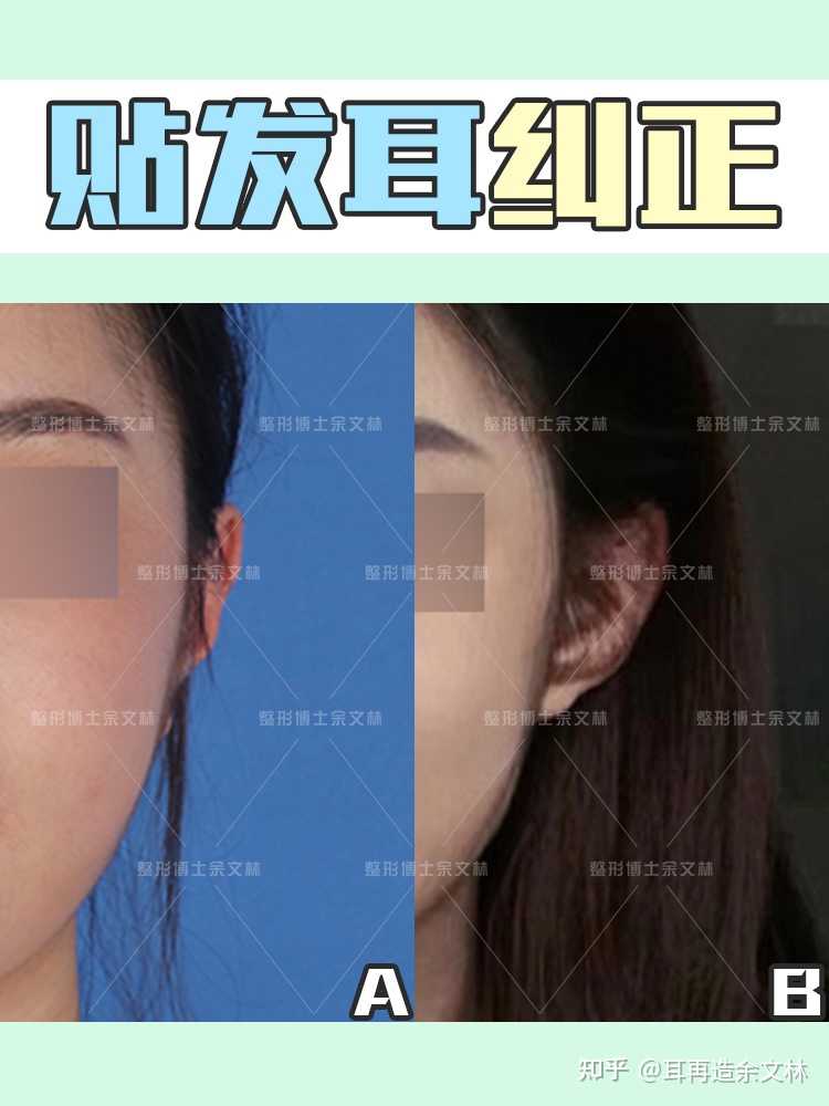 貼發耳矯正是怎麼做的