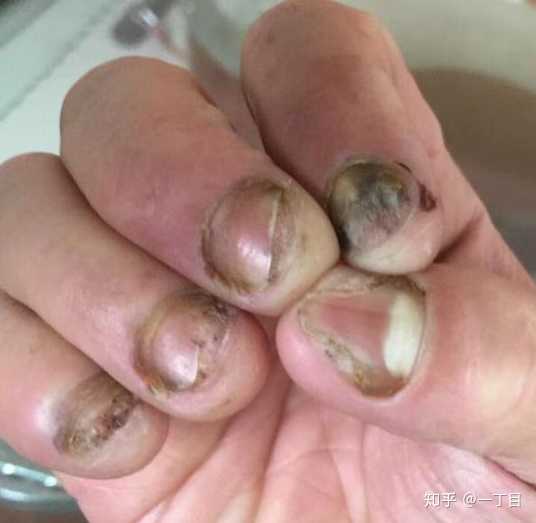 如果你的舍友得了灰指甲,你会嫌弃她吗?或者说你怎么看待她?