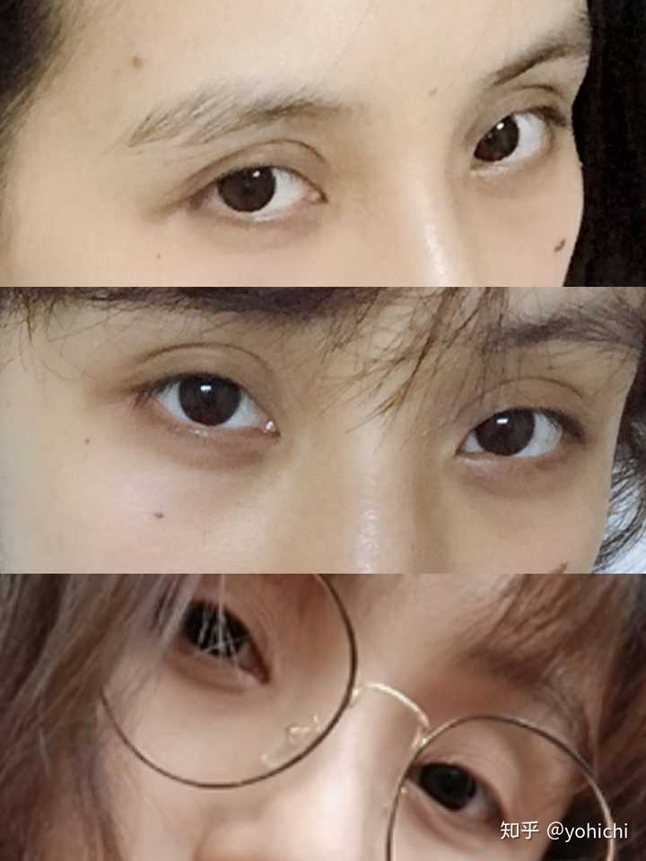 天生双眼皮太像割的是种怎样的体验?