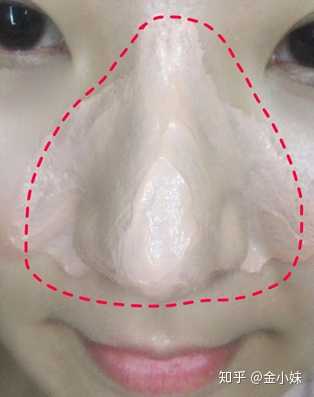 如何去除鼻子上的黑头 知乎