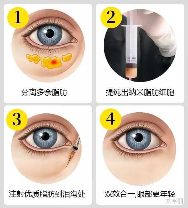 怎么那快速消除泪沟? - 知乎
