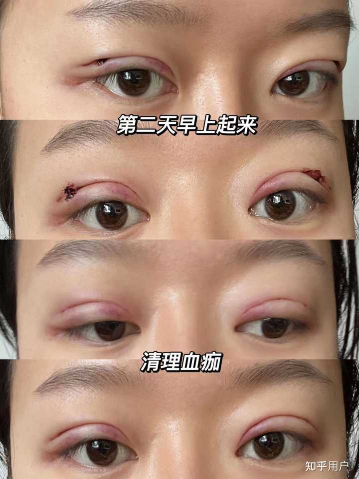 双眼皮法埋线价格多少_埋线法双眼皮价格_双眼皮埋线价格