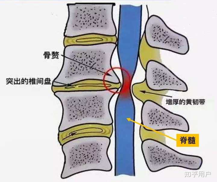如何治疗胸椎黄韧带增厚? - 知乎