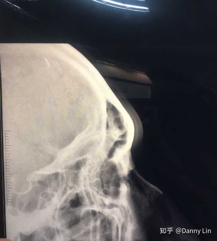 鼻子骨折后图片 搜狗图片搜索