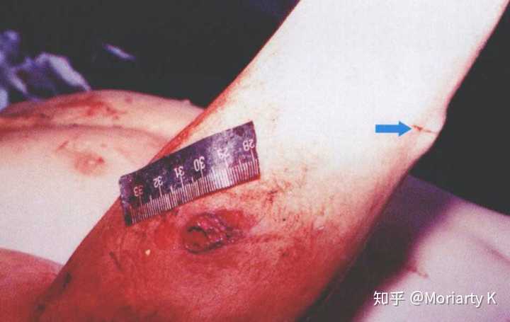 为什么中枪后要马上取出子弹