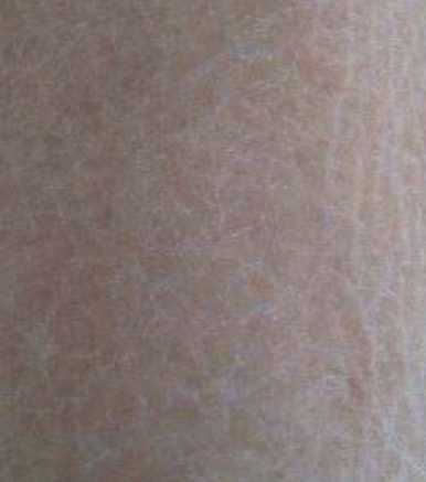 脱毛仪属于医疗器械吗