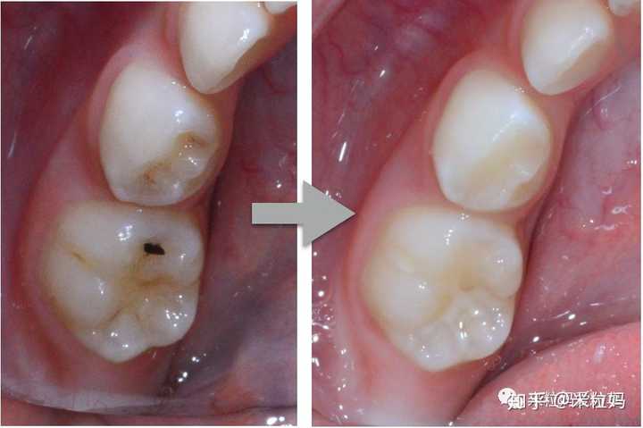 小孩预防虫牙 有什么好的办法 知乎