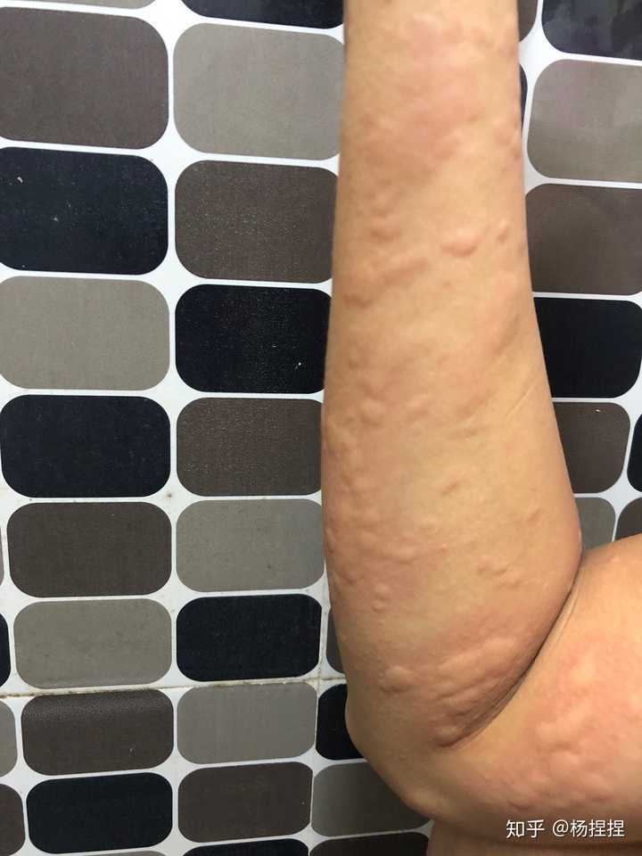 有没有人对甲醛过敏?过敏是什么反应?