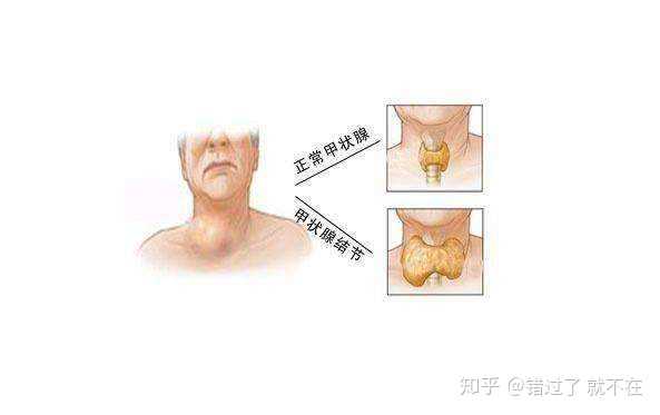 甲状腺右侧叶结节？