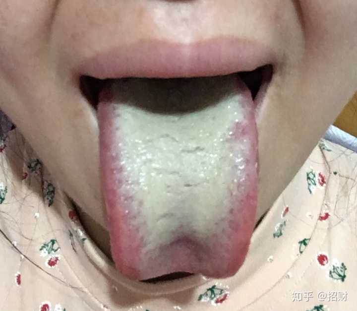舌苔发白 发黄 厚 怎么办 知乎 舌苔发白 发黄 厚 怎么办 知乎