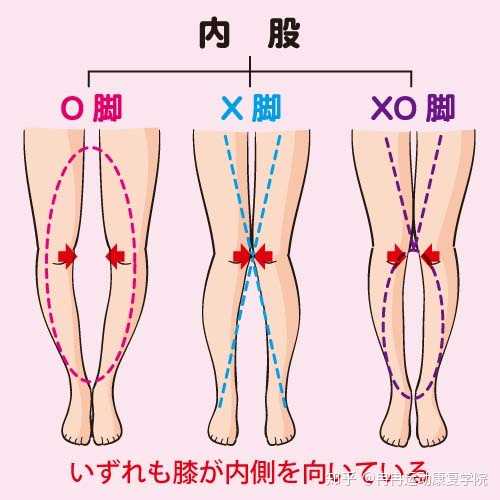 请问 胫骨内旋o型腿 怎么能够得到有效的矫正锻炼 知乎 请问 胫骨内旋o型腿 怎么能够得到有效的矫正锻炼 知乎