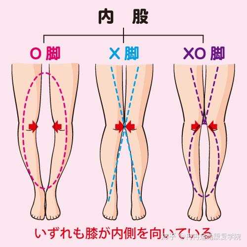 请问 胫骨内旋o型腿 怎么能够得到有效的矫正锻炼 知乎