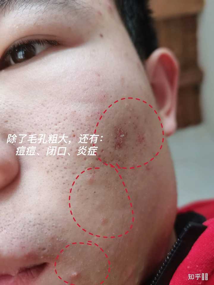 我脸上的黑头怎么办?求救!!!? - 知乎