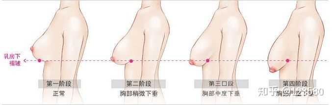 19岁女生有些胸下垂怎么才可以恢复 知乎