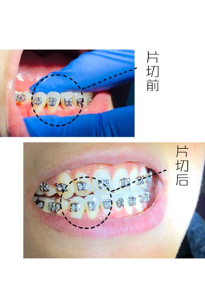 对于因为牙齿形态造成的黑三角,可通过适当的邻面去釉(片切)修整邻接