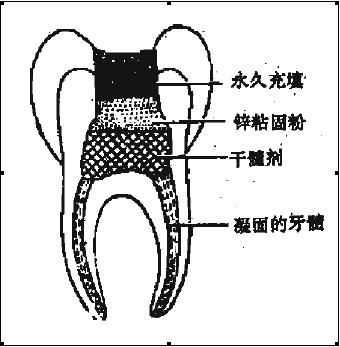 术①原理:牙髓也就是所谓的"牙神经"位于牙内部的一个中空的硬组织中