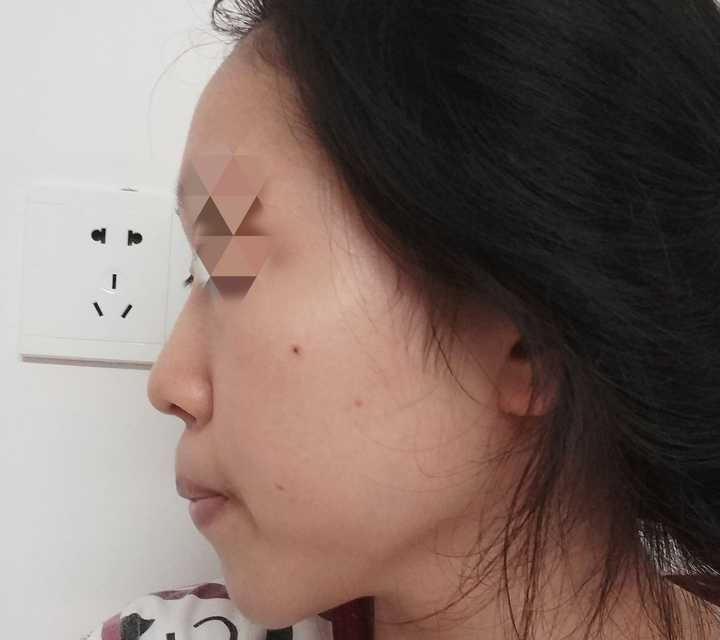 可以说是很严重的腺样体面容了,从小有鼻炎,晚上张口才能呼吸,曾经去