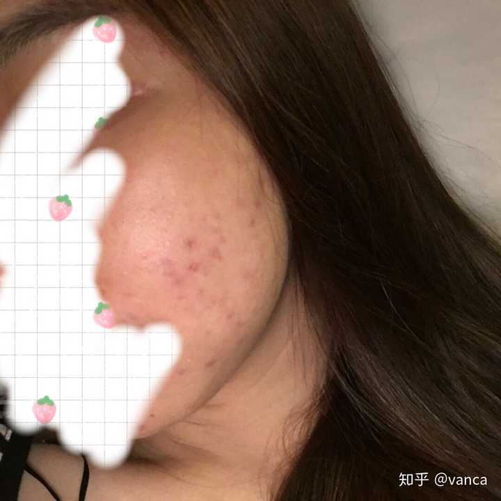怎样去痘痘 消痘印 知乎 怎样去痘痘 消痘印 知乎
