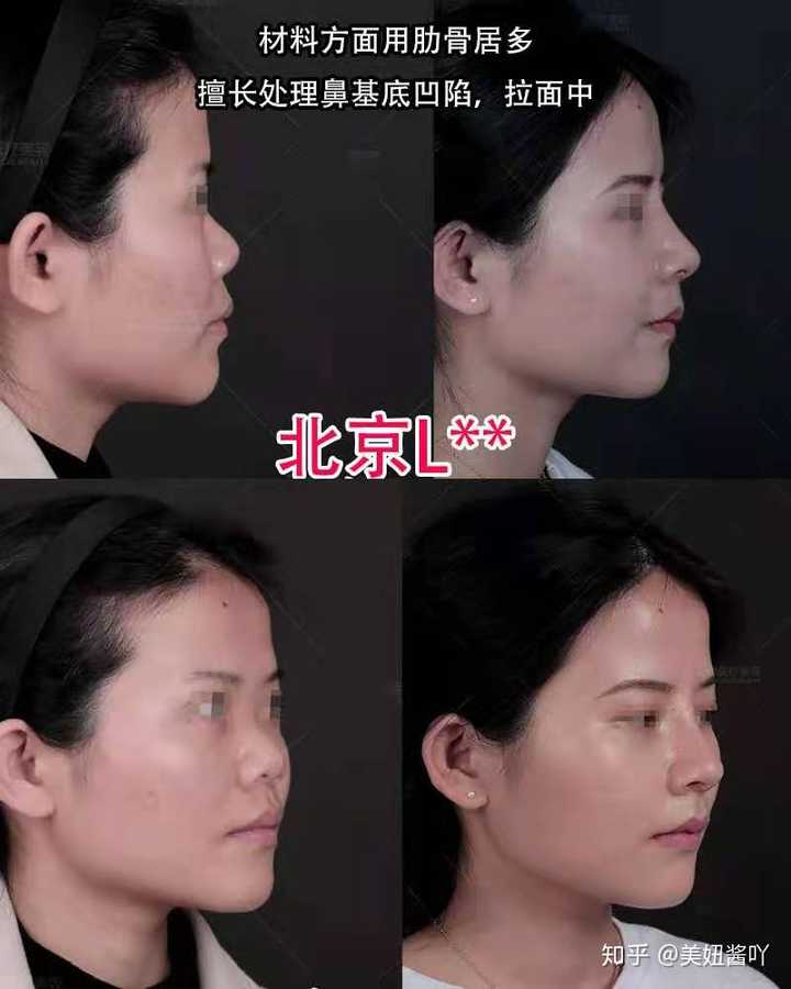 做鼻综合是什么体验 知乎