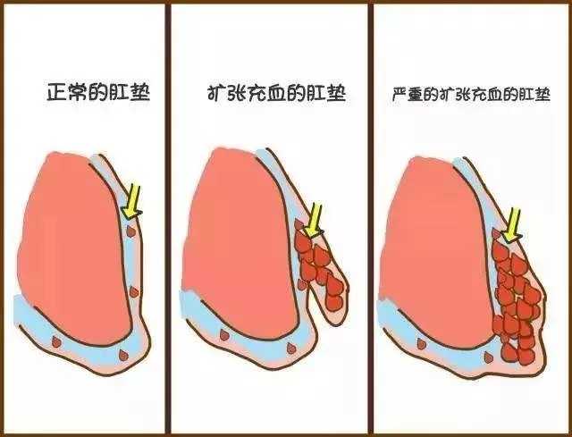 痔疮怎么引起的啊 知乎