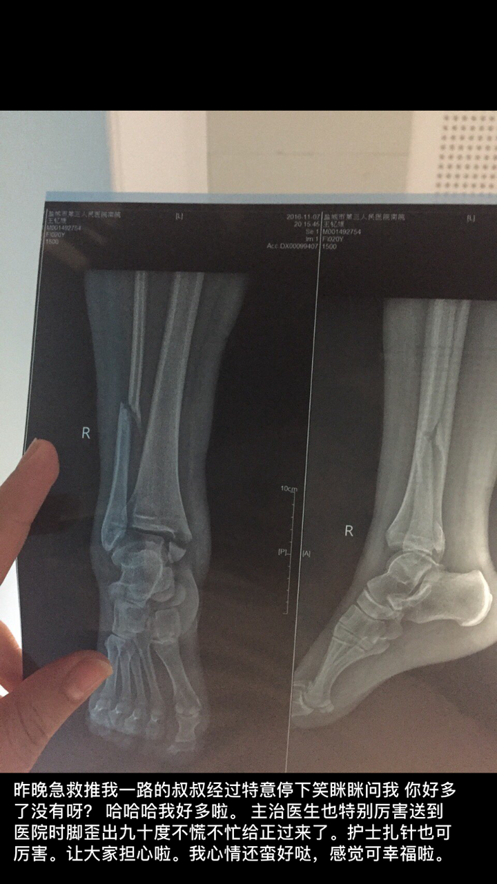 骨折是一种什么样的体验 知乎 骨折是一种什么样的体验 知乎
