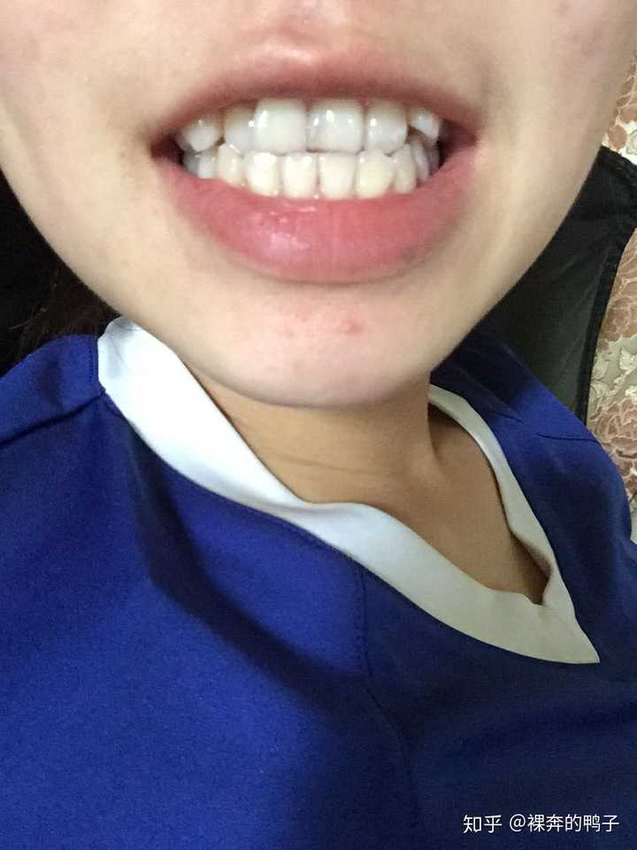 牙齿美白?用什么方法?谢谢