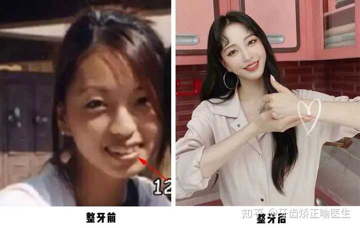 整牙成功是什么体验 知乎