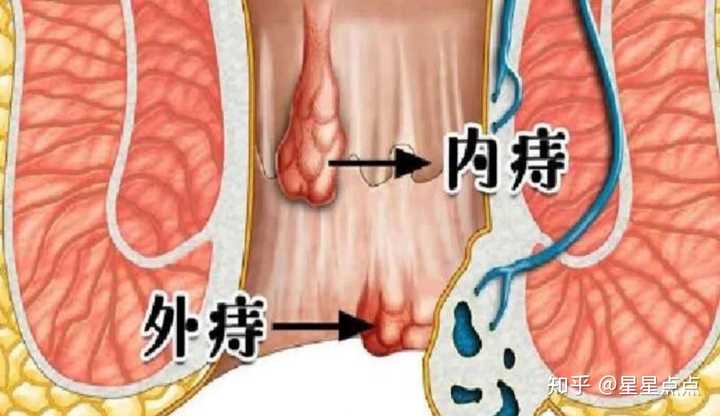 轻微痔疮能自愈吗图片