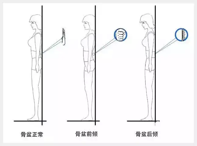 怎么矫正骨盆后倾 知乎