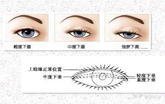 提眼肌手术的原理和步骤是什么?