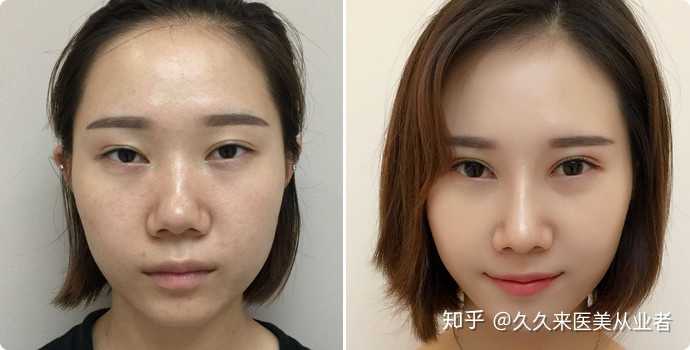 如今市面的注射隆鼻 假体隆鼻 线雕隆鼻 鼻综合等鼻整形技术之间有何优劣 知乎